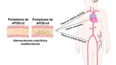 Gen relacionado con el alzhéimer y aterosclerosis subclínica