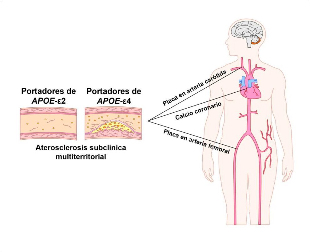 Gen relacionado con el alzhéimer y aterosclerosis subclínica