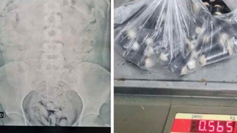 Ciudadana boliviana con cápsulas de droga