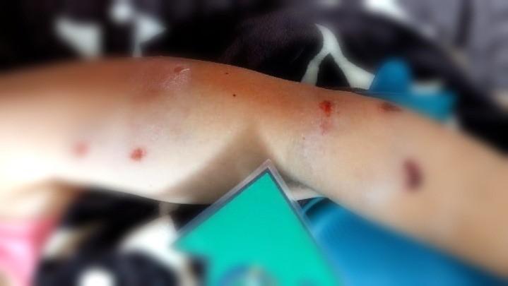 heridas por mordedura de perros