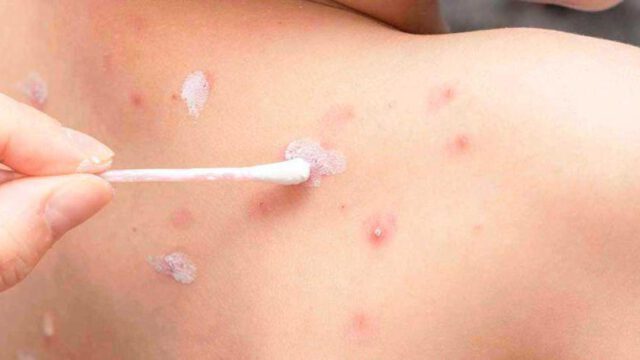 El registro de 43 nuevos positivos eleva la cifra acumulada a un total de 524 contagios de varicela