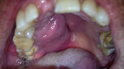 Cáncer de cavidad oral en Santa Cruz