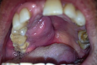 Cáncer de cavidad oral en Santa Cruz