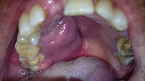Cáncer de cavidad oral en Santa Cruz
