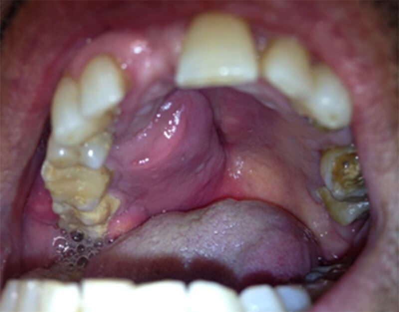 Cáncer de cavidad oral en Santa Cruz