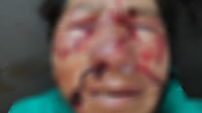 Ataque de perros en Huanuni