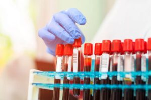 test de sangre para detectar cáncer en pacientes