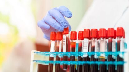 test de sangre para detectar cáncer en pacientes