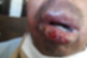 Paciente con Leishmaniasis mucocutánea