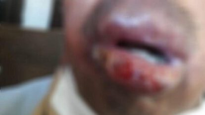 Paciente con Leishmaniasis mucocutánea
