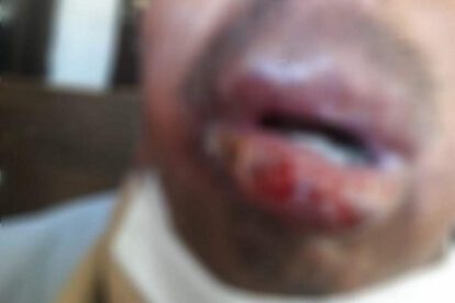 Paciente con Leishmaniasis mucocutánea