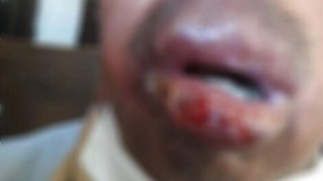 Paciente con Leishmaniasis mucocutánea