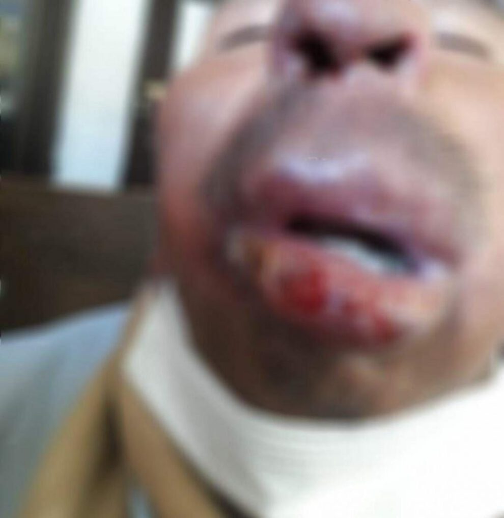 Paciente con Leishmaniasis mucocutánea