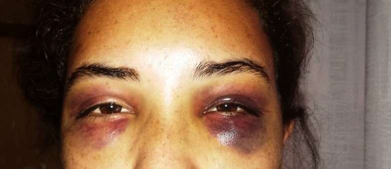 Mujer agredida en Santa Cruz logra huir de su agresor