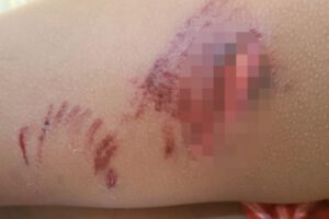 Mordedura de perros en Oruro