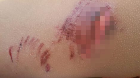 Mordedura de perros en Oruro