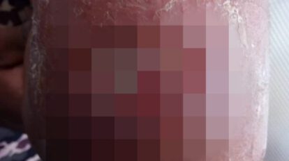Detectan nuevo caso de Leishmaniasis en Oruro