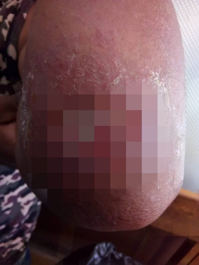 Detectan nuevo caso de Leishmaniasis en Oruro