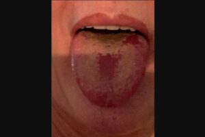 Lengua Covid, nuevo síntoma del coronavirus