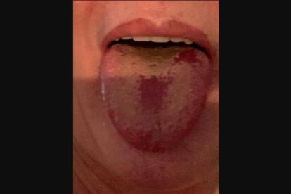 Lengua Covid, nuevo síntoma del coronavirus
