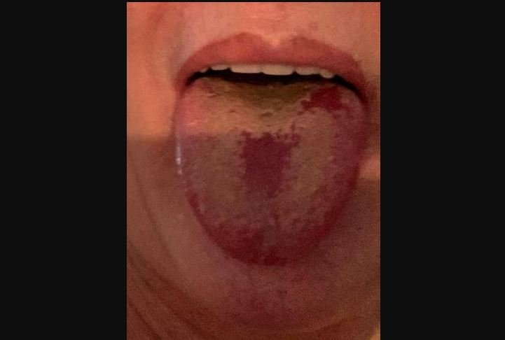 Lengua Covid, nuevo síntoma del coronavirus