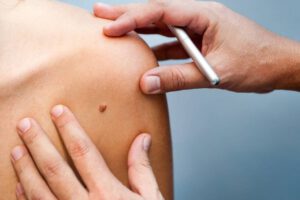 Lunares cancerígenos: ¿Cómo detectarlos?