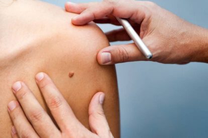 Lunares cancerígenos: ¿Cómo detectarlos?