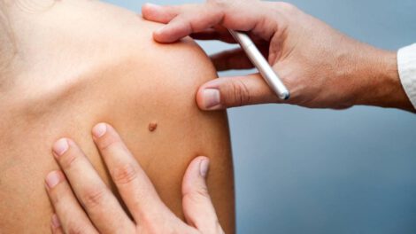 Lunares cancerígenos: ¿Cómo detectarlos?