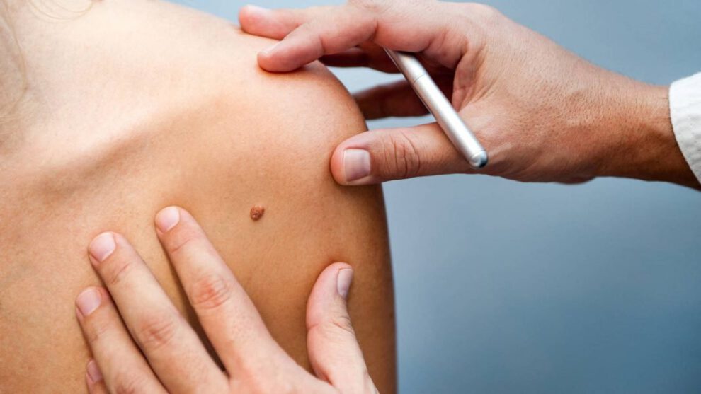 Lunares cancerígenos: ¿Cómo detectarlos?