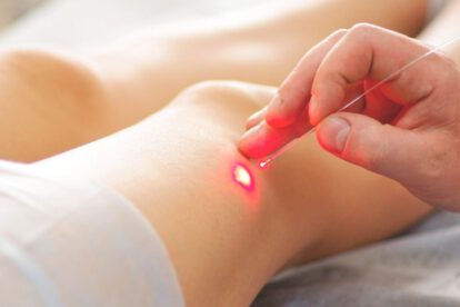 Tratamiento de varices mediante el endoláser