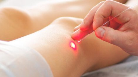 Tratamiento de varices mediante el endoláser