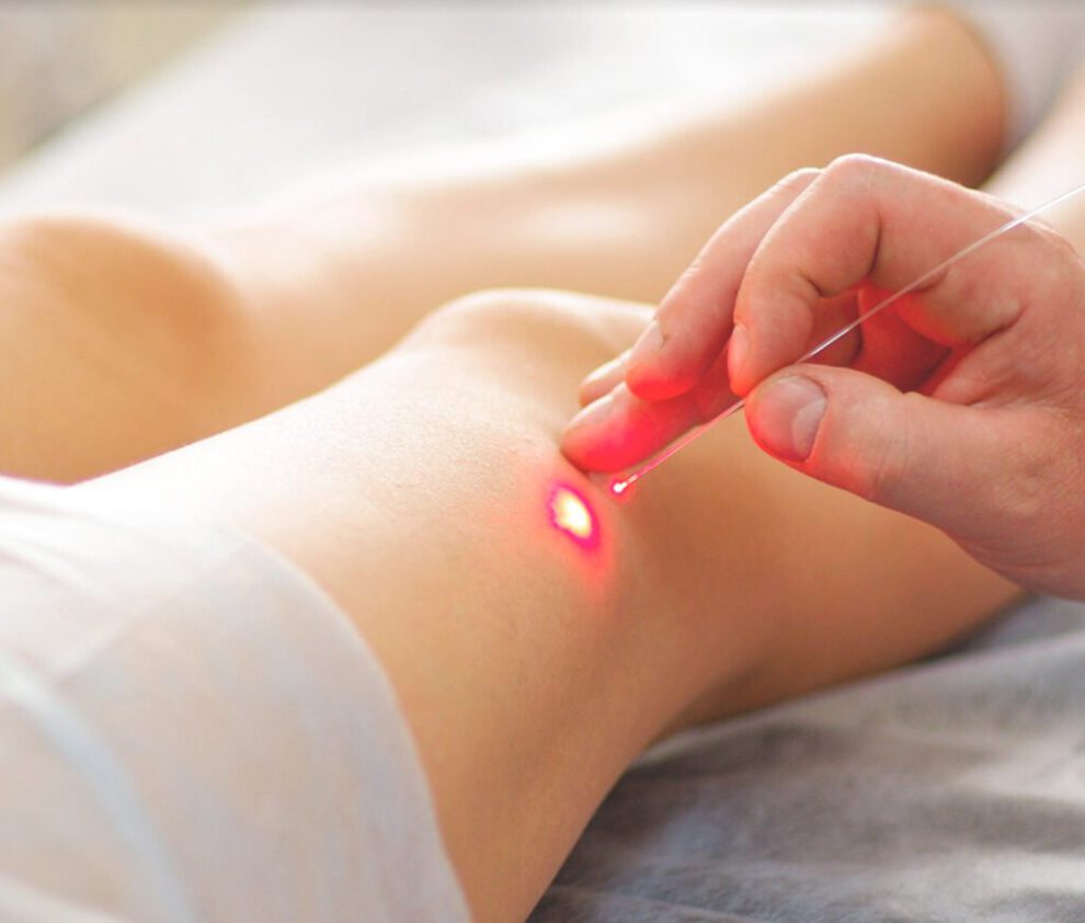 Tratamiento de varices mediante el endoláser