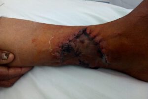 Víctimas de ataques de can requieren ayuda psicológica
