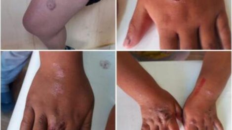 Agresiones físicas a menores en Potosí