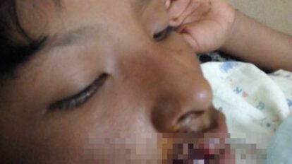 Adolescente mordido por perro pastor alemán