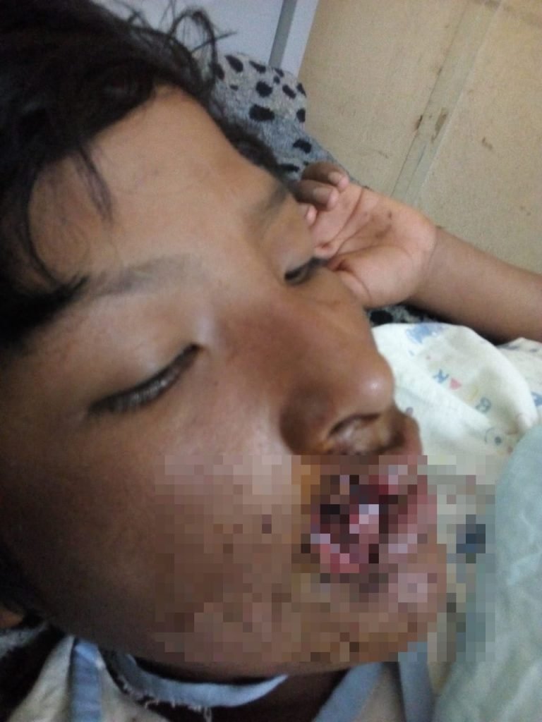 Adolescente mordido por perro pastor alemán