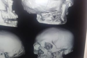 muerte cerebral en Cochabamba