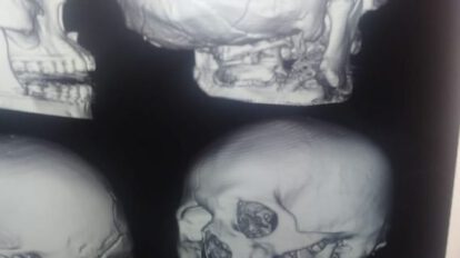muerte cerebral en Cochabamba