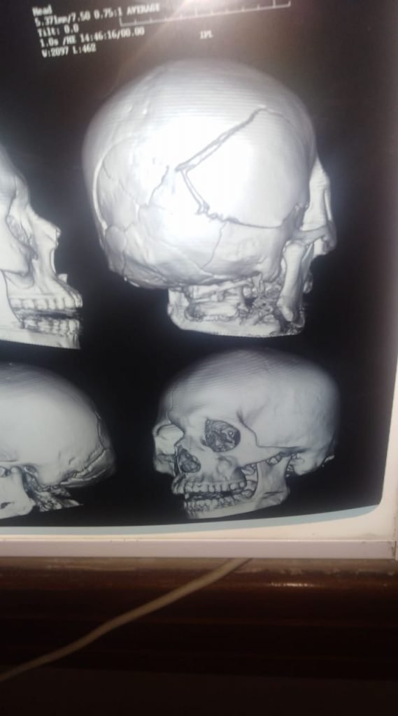 muerte cerebral en Cochabamba