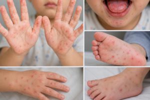Virus Coxsackie