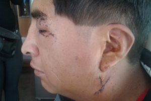 Rottweiler muerde a un hombre en la cara