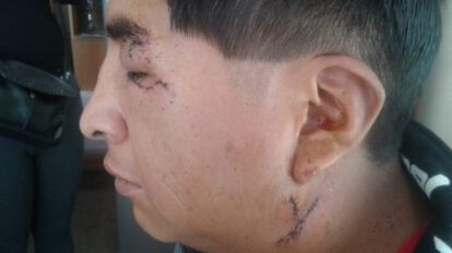 Rottweiler muerde a un hombre en la cara