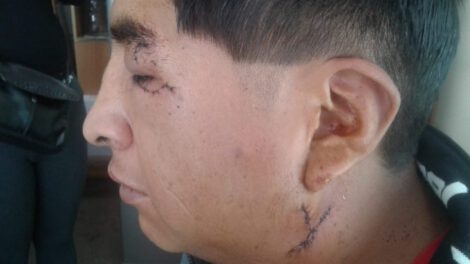 Rottweiler muerde a un hombre en la cara