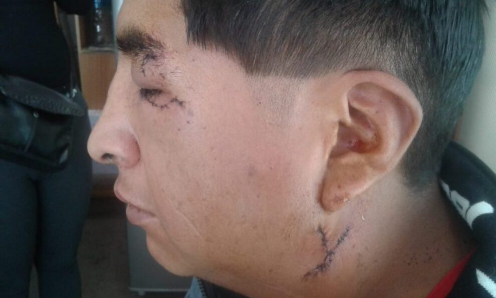 Rottweiler muerde a un hombre en la cara