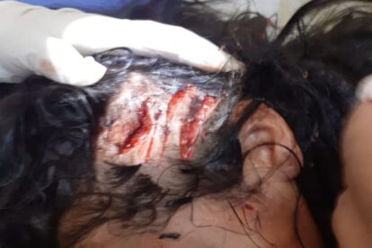 Médicos observan la gravedad del ataque de mordedura de can
