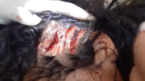 Médicos observan la gravedad del ataque de mordedura de can