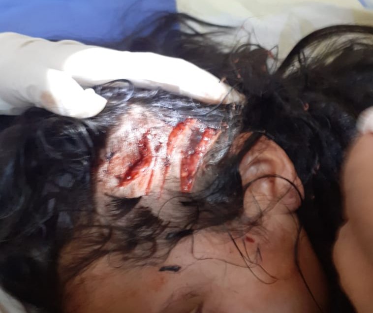 Médicos observan la gravedad del ataque de mordedura de can