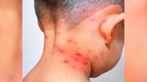 El cuello de un niño con varicela