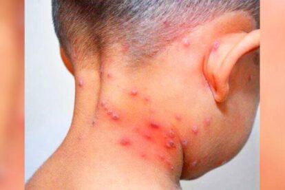 El cuello de un niño con varicela