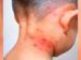 El cuello de un niño con varicela